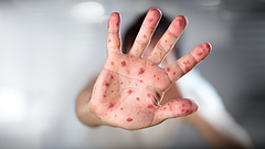 Sokkoló számokat közölt a WHO a fertőző kórról